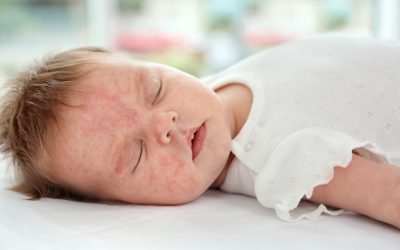 What Are Newborn Rash, Acne, And Contact Dermatitis?