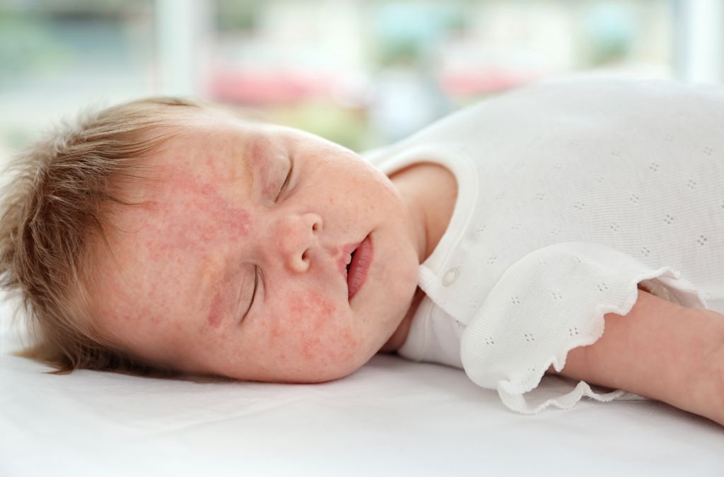 What Are Newborn Rash, Acne, And Contact Dermatitis?