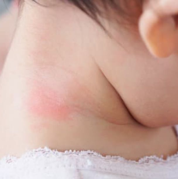 parenting tips for hives