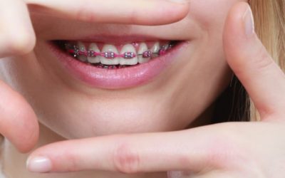 Signs Your Child May Need Braces