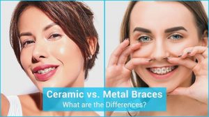 What is the difference between metal and ceramic braces