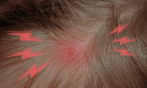 A Medical Condition Can Cause Hair Loss
