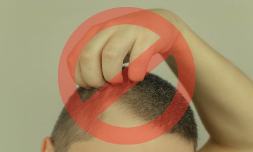 Avoid Scratching Or Rubbing The Scalp