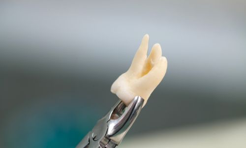wisdom tooth removal for oral health