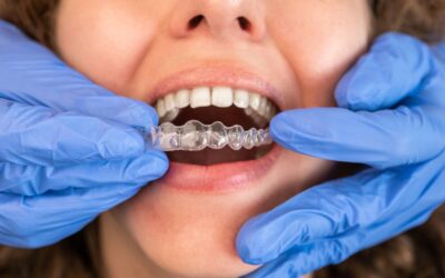 The Benefits of Invisalign Treatment