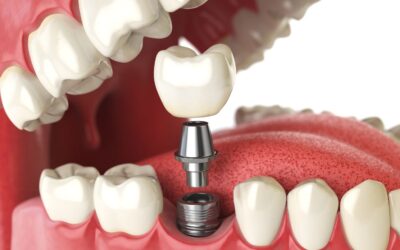 How To Handle A Broken Dental Implant While On Vacation