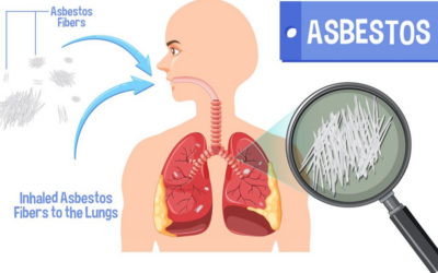 Asbestos: A Dangerous Mineral That Causes Lung Cancer