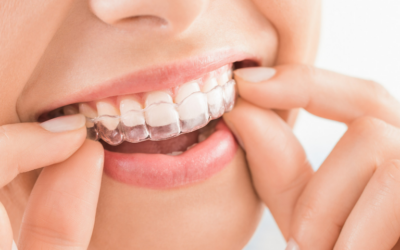 The Truth About Invisalign: Is It Right for You