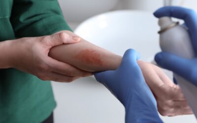 What to Do Immediately After Suffering a Burn Injury