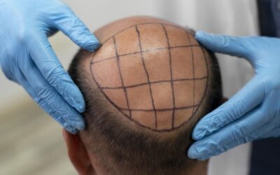 Hair Restoration – How to Make Your Hair and Confidence Better