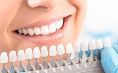 How Long Does Professional Teeth Whitening Last? A First-Timer’s Guide